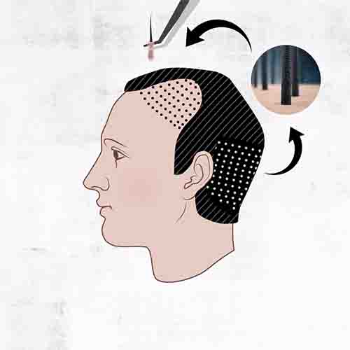 fue-haartransplantation-haarwerkengregory